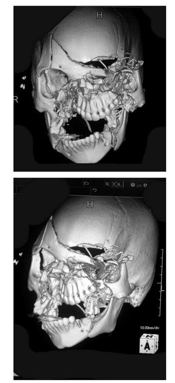 썸네일-오토바이 타다가 사고난 사람의 CT 사진-이미지