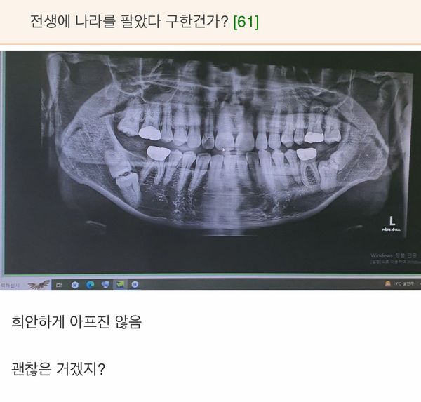 썸네일-흔한 매복 사랑니 상태-이미지