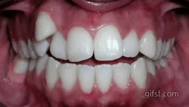 썸네일-치아 교정 과정.gif-이미지