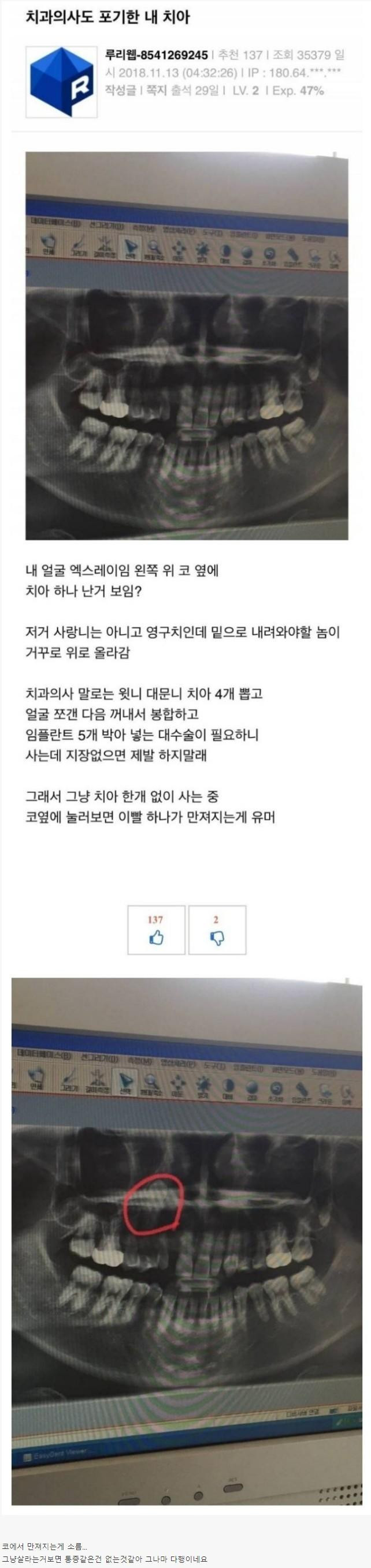 썸네일-치과의사도 포기한 영구치-이미지