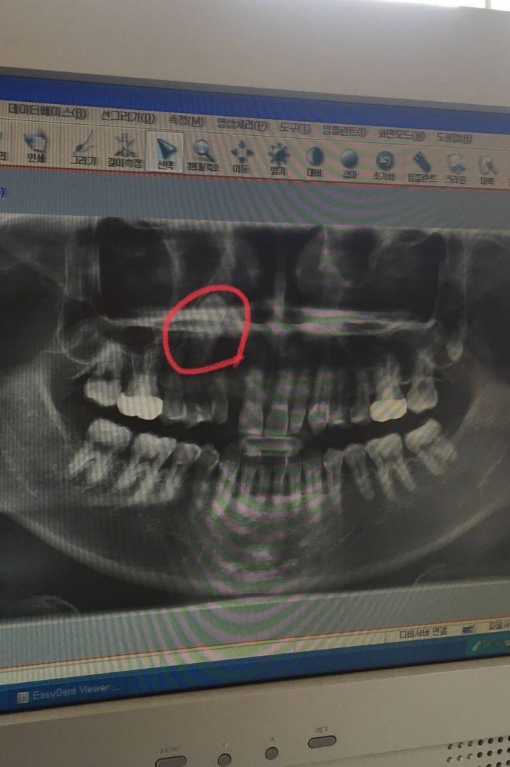 nokbeon.net-치과의사도 포기한 치아-3번 이미지