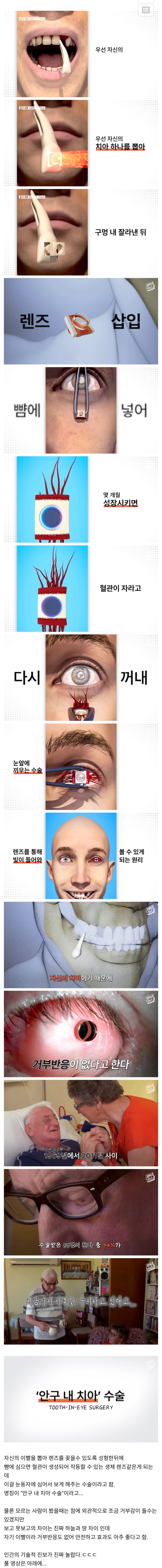 썸네일-치아를 눈에 넣어 실명을 치료하는 안구 내 치아 수술.jpg-이미지